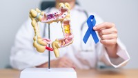 5 Hal yang Dianggap Sepele Ini Ternyata Tingkatkan Risiko Kanker Usus Besar