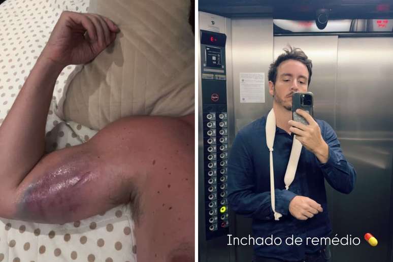 Ator da Globo Wagner Santisteban mostra hematomas após acidente na academia: 'Doendo muito'