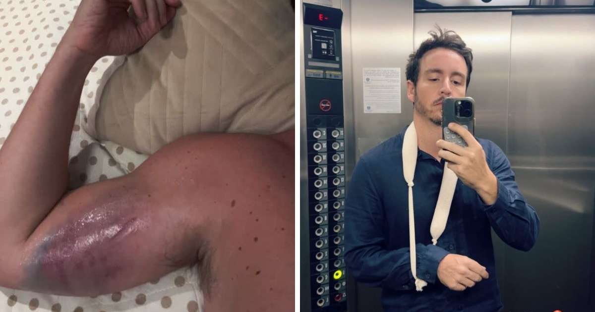 Ator da Globo Wagner Santisteban mostra hematomas após acidente na academia: 'Doendo muito'