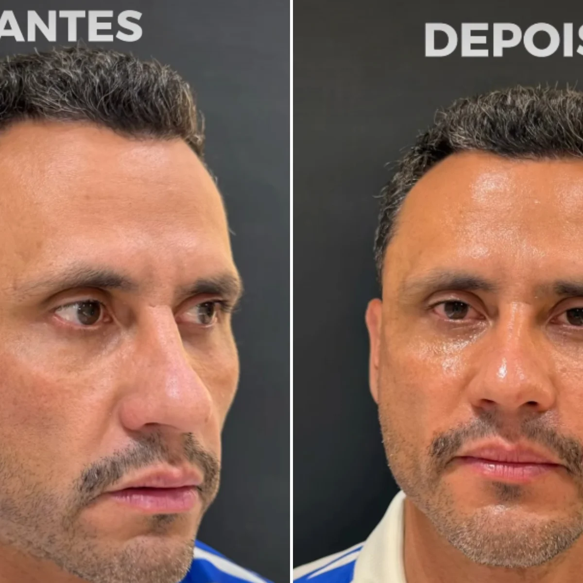 Eleito e harmonizado: Cleitinho faz procedimentos no rosto após campanha